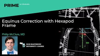 Equinus Correction with Hexapod Frame  Philip McClure MD [upl. by Ulland229]