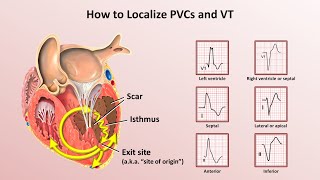 Advanced EKGs  Ventricular Tachycardia Classification amp Localization [upl. by Ayikahs944]