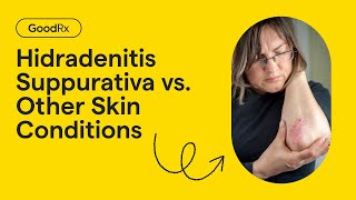 Hidradenitis Suppurativa vs Other Skin Conditions How to Tell the Difference  GoodRx [upl. by Arondel765]