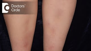 How to manage Lichen Planus present in the legs  Dr Rajdeep Mysore [upl. by Sateia]