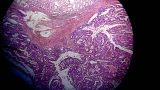 adenocarcinoma colon [upl. by Vasya]