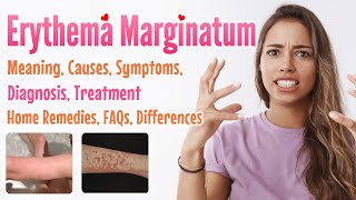 Erythema marginatum overview meaning signs and symptoms diagnosis treatment home remedies FAQs [upl. by Glasgo]