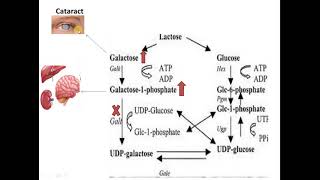 Galactosemia Galactose metabolism disorder [upl. by Michel]