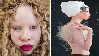 South African Albino Beauty Become A Model [upl. by Shorter]