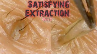 Blackhead  Whiteheads Extraction using tweezer part 2 [upl. by Elisha35]