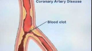 Entendiendo la Angioplastia Coronaria [upl. by Nnaeoj]