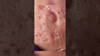 Satisfying Blackhead Removal Clear Skin Transformation Part 10 [upl. by Nilyak]