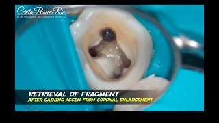 removal fractured broken endodontic file with ultrasonic tip ET 18 D et 20 satelec mandibular molar [upl. by Cherlyn]