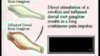 Adhesive Arachnoiditis Stages of Development and Common Cause [upl. by Peregrine663]