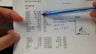 Hematology How to interpret automated Complete Blood Count CBC results [upl. by Niuqauj]