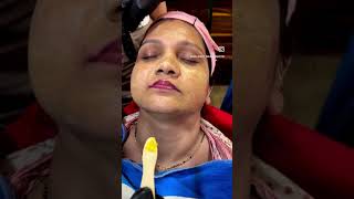 Yellow peel treatment [upl. by Kavita]