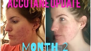 My Accutane Journey  2 Month Update [upl. by Eninahs17]