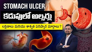 Stomach ulcer symptoms and treatment  Gastric problem  గ్యాస్ట్రిక్ సమస్య  Ulcer Dr Ujwal Gajula [upl. by Elag]