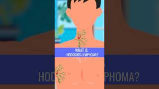 What is HODGKINS LYMPHOMA [upl. by Scutt]