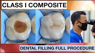 Dental Filling Full Procedure Class I Composite  General Dentist Griya RR [upl. by Jarvis]