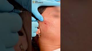 Subcision for Acne Scars  Acne Scar Treatment  Cheek Acne Scar Removal  Dr Pooja Kasana [upl. by Helyn]