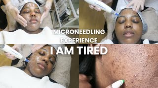 Microneedling GONE WRONG acne hyperpigmentation pimple popping [upl. by Perlman]