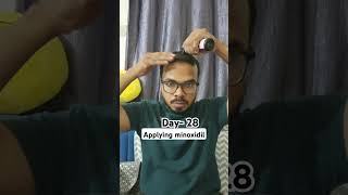 Day 28 Hair Regrowth journey Applying minoxidil bald minoxidil minoxidilresult hairloss [upl. by Suivart]