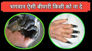 एक एसी खतरनाक बीमारी  Gangrene Symptoms and causes  gangrene kyu hota hai  Dr tarun [upl. by Nikral853]