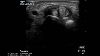 Wrist Ultrasound De Quervains Tenosynovitis Corticosteroid Injection [upl. by Aissirac]