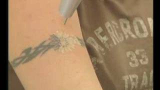 Laser Tattoo Removal with the MedLite [upl. by Eanram]