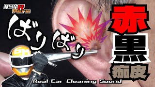 【ばりばり！本物耳かきASMR】赤黒痂●登場！ピンセットオンリー耳掃除引掻き音音フェチマッサージ痒い【音声：左のみ→右のみ→W再生】 [upl. by Elke]