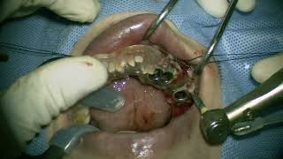 Straumann NC RN WN place in posterior mandible 2 [upl. by Eliathan]