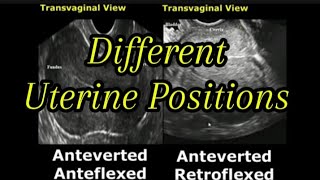 Uterine Positions In Ultrasound  AntevertedRetroverted  AnteflexedRetroflexed Uterus [upl. by Eanram]