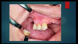 Oral Surgery L1 Preprosthetic Surgery [upl. by Inalan]