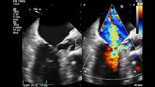 Echo and Systolic anterior motion S A M [upl. by Noned]