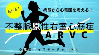 【不整脈原生右室心筋症 ARVC】病態から心電図をマスターする！心電図検定対策 医師国家試験対策 循環器専門医試験対策 [upl. by Aliac]