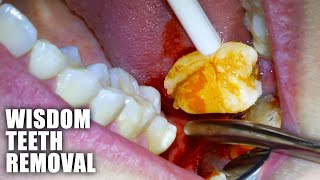 Full Wisdom Teeth Removal Procedure Emergency Extraction of Impacted amp Partially Erupted Molar [upl. by Erickson80]