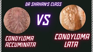 Condyloma Accuminata vs Condyloma Lata  Dermatology  FMGE NEETPG INICET [upl. by Einamrej]