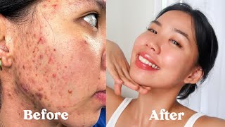 ENG SUB HOW I GOT RID OF MY ACNE SCARS TEXTURE amp HYPERPIGMENTATION not sponsored [upl. by Ariam]