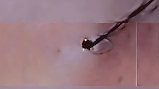 Removal of ingrown hair [upl. by Evilc861]