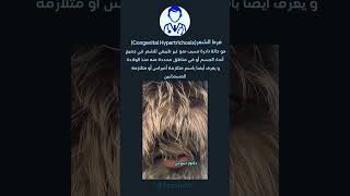 فرط نمو الشعرCongenital Hypertrichosis دكتورسيرجن اكسبلور طب [upl. by Odel]