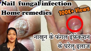 Paronychia Treatment Home Remedies In Hindi finger infection home remedy \nail fungus treatment [upl. by Anairdna]