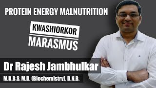 PROTEIN ENERGY MALNUTRITION PEM Kwashiorkor and Marasmus [upl. by Robina]