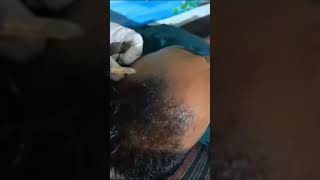 PRP for stimulating hair growth and preventing hair loss in Tehseeni healthcare centre [upl. by Nnylyrehc]