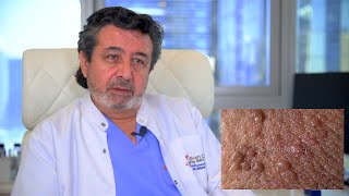 Best Warts Removal With Laser Treatment and kills the HPV virus [upl. by Vallie]