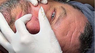 Acne Treatment Huong Da Nang Educational Video [upl. by Poole]