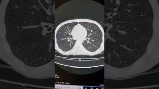 Alveolitis bronchiolitis and mild bronchiectasis [upl. by Handy]