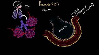 Occupational respiratory disorders  Breathing and exchange of gases  Biology  Khan Academy [upl. by Atsahc]