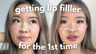 first time getting lip filler  4 week healing process vlog [upl. by Romito]