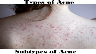 Types And Subtypes Of Acne [upl. by Kali]