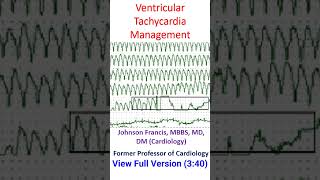 Ventricular Tachycardia Management [upl. by Aramoj]