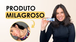 Como tratar acne com peroxido de benzoila  minha experiência com fotos [upl. by Meadows161]