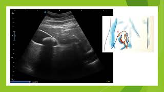 Lithiase vésiculaire en échographie pièges et astuces [upl. by Yecies]