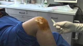 Knee Injection HDmp4 [upl. by Ykciv]