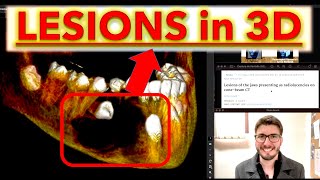 All Radiolucent Lesions with CBCT Periapical radiolucencies Cysts OKC Ameloblastoma lecture [upl. by Gnil48]